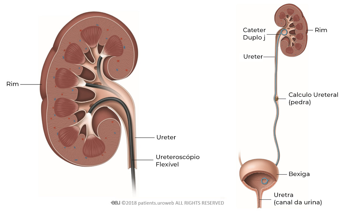 Ureteroscopia - UROBH - Urologia Minimamente Invasiva